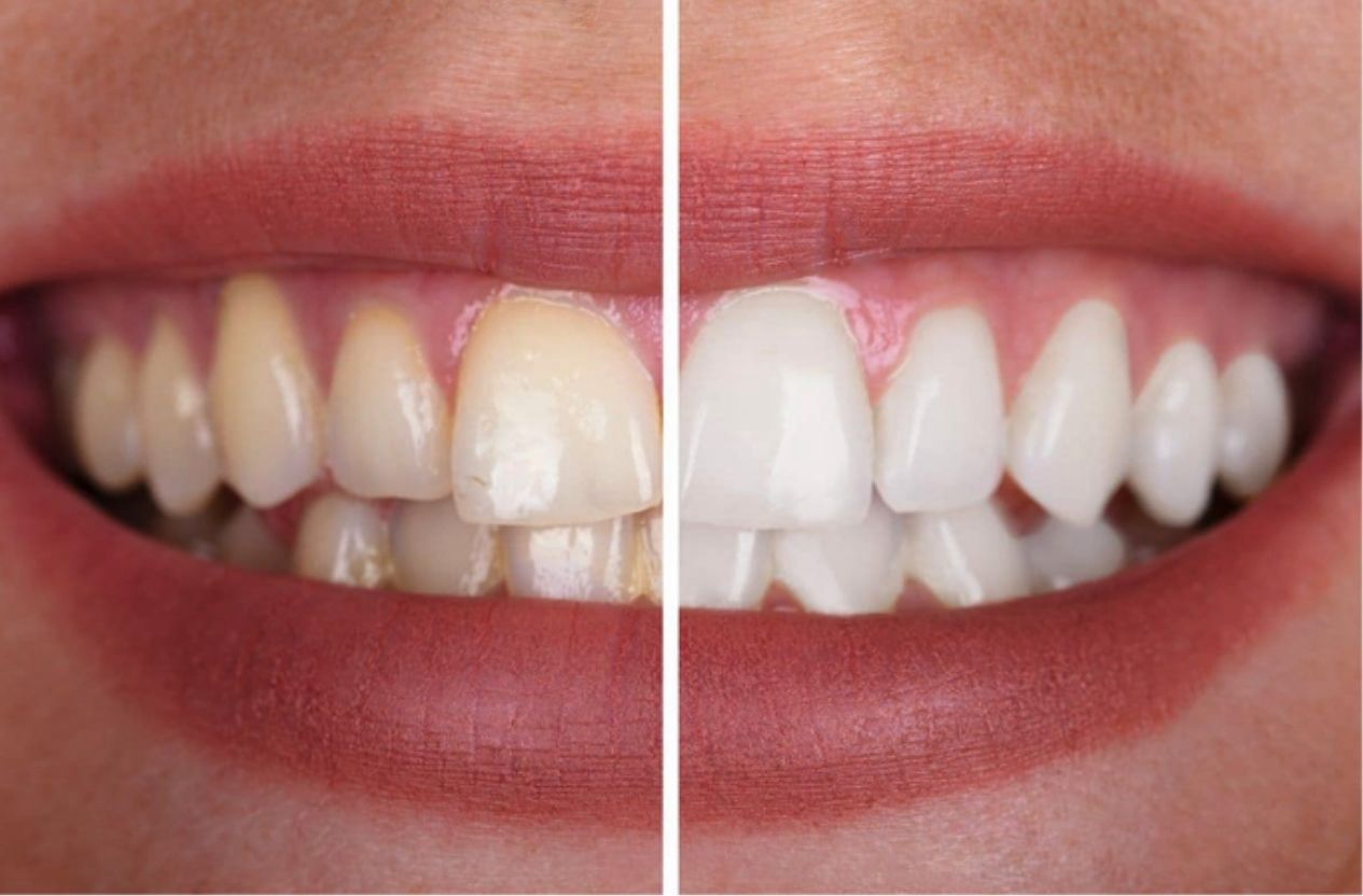 Whitening
